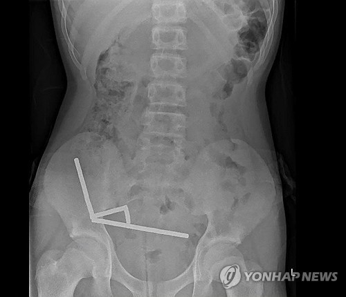 '초강력 자석' 100개 삼킨 뉴질랜드 소년…"온라인 카지노 주소에서 구입했다"