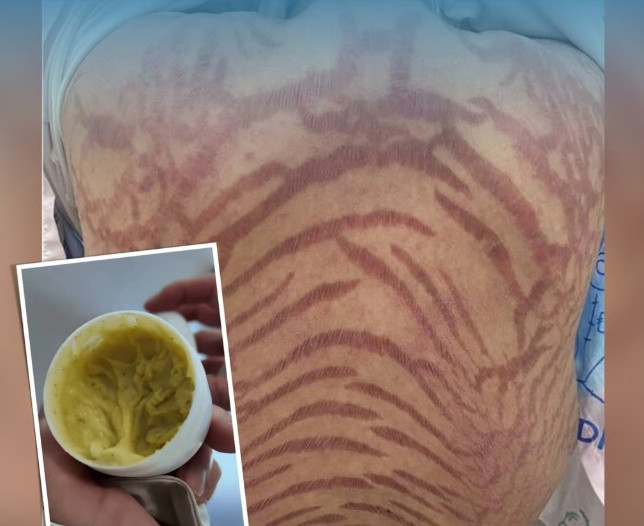 온 몸 뒤덮은 '호랑이 무늬' 피부 질환…10년 쓴 '중의학 연고'의 배신