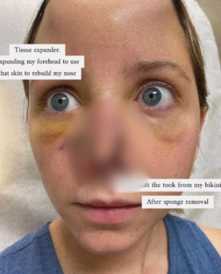 개한테 코 물려 절단…16차례 '얼굴 재건' 수술 견딘 미국 여성