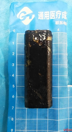 30년 전 술 취해 '온라인카지노 순위 온카판터' 삼킨 중국 남성…수술로 꺼냈더니 시커멓게 부식