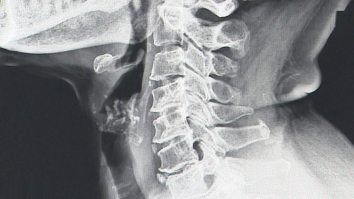 스마트폰 사용으로 목디스크 환자 급증…5년새 24% ↑