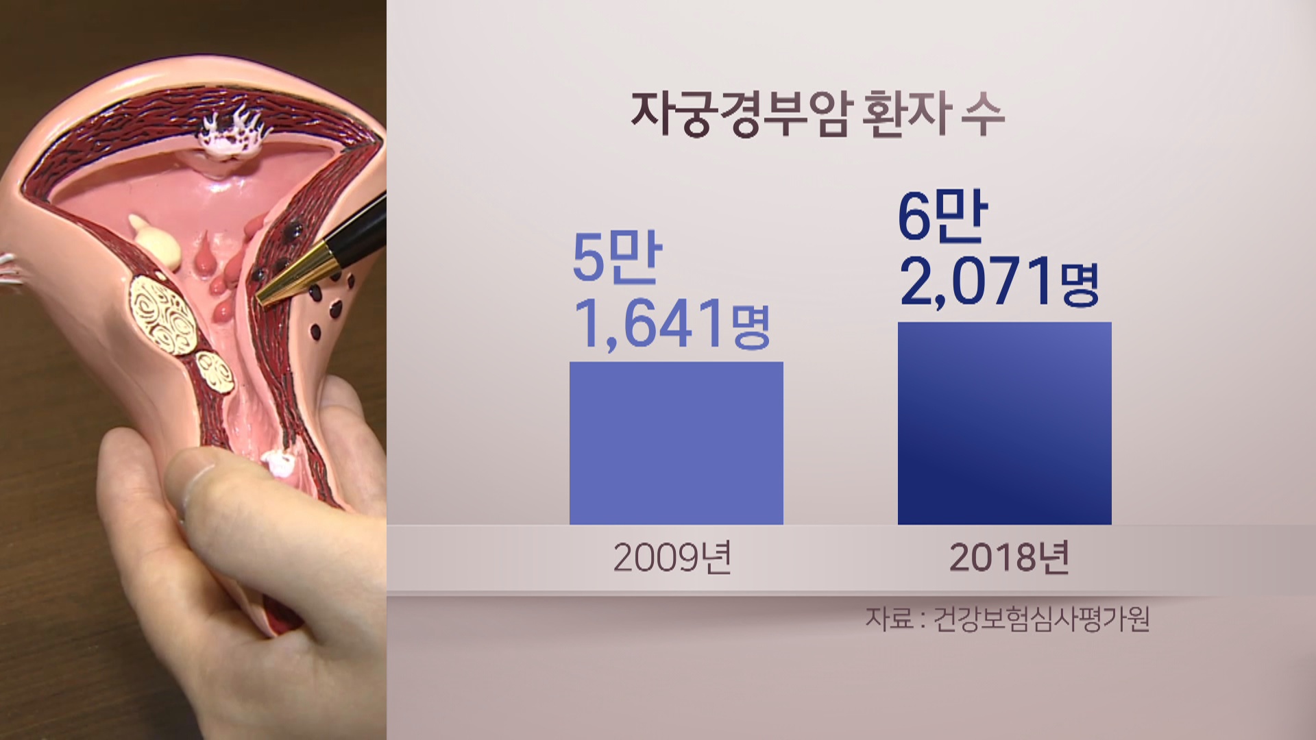 한국만 늘어나는 자궁경부암…비싼 백신도 원인