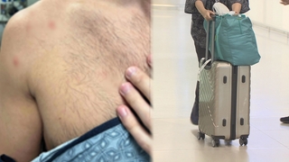 원숭이두창 2번째 환자 발생…지난달 18일 입국 내국인