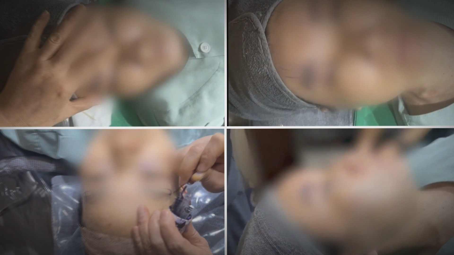 "눈이 안 감겨요"…불법 성형수술 사무장병원 적발