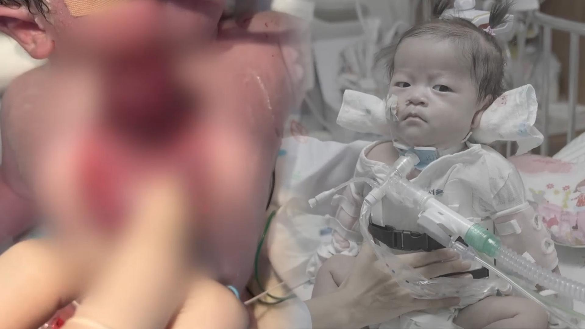 온라인카지노 후기 유니88 몸밖에 나온채 태어난 신생아 생존기 화제